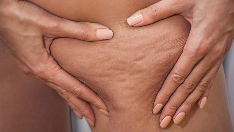 Things to know about cellulite treatments