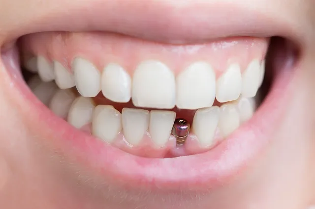 Beyond Dentures: The Magic of Dental Implants 