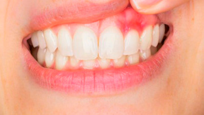 How Proper Brushing Can Prevent Gum Disease?